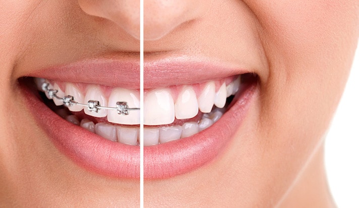 invisalign vs braces