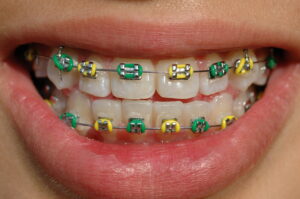 cute braces colors combinations for girls