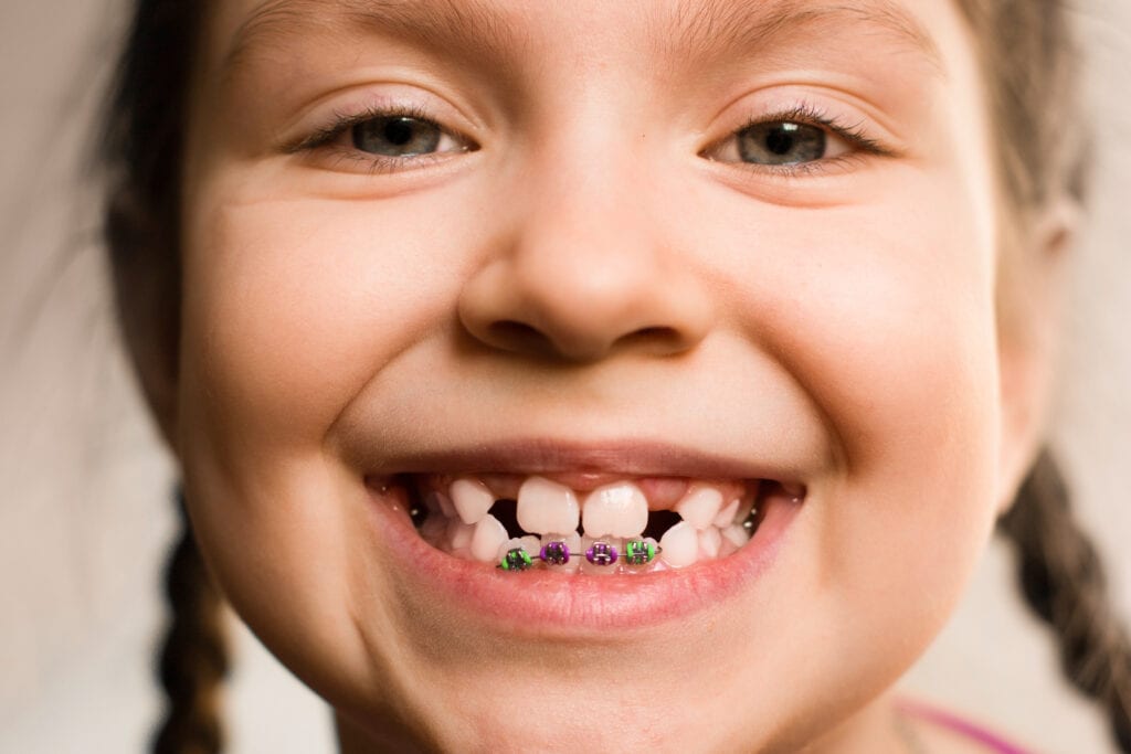 Close up portrait of Smiling girl showing dental braces.