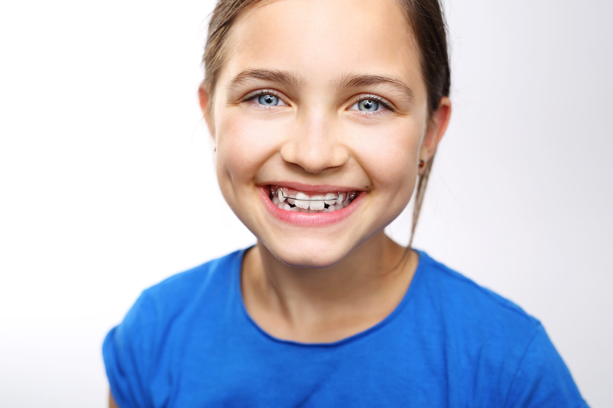 Two Phase Treatment Okc Braces Craig And Streight Orthodontics 0724