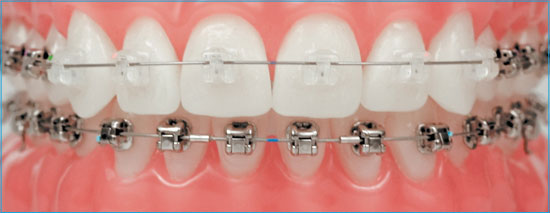 Ceramic braces on front teeth