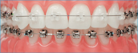 Benefits of Braces Besides Straight Teeth – Blog