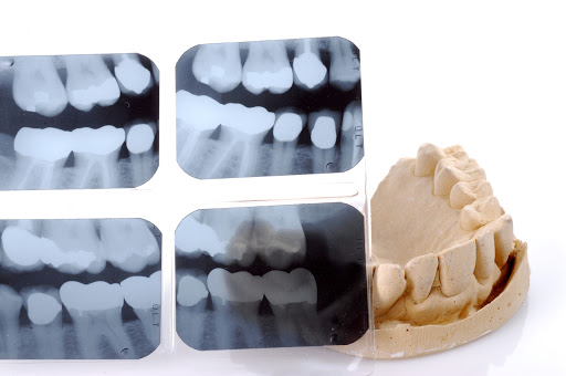 Dental XRays